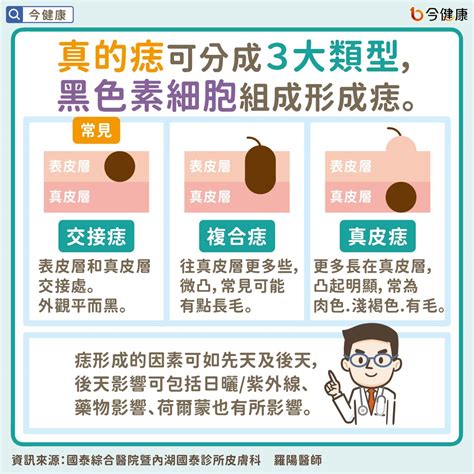 為什麼會長痣|是痣？皮膚癌？還是什麼？常見Q&A解惑！醫教揪出「假的痣」